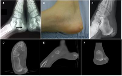Case Report: Unusual Heterotopic Ossification of the Hindfoot